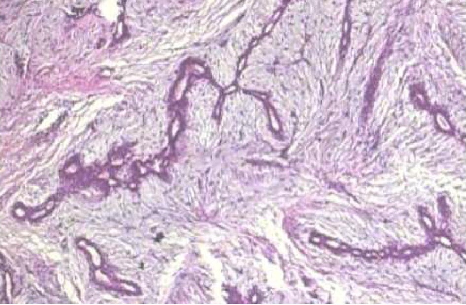 Breast histopathology H&E slide