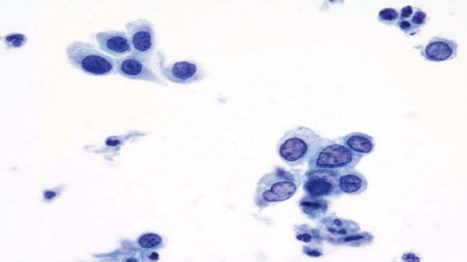 Pap smear cytology — cervical cells under microscope